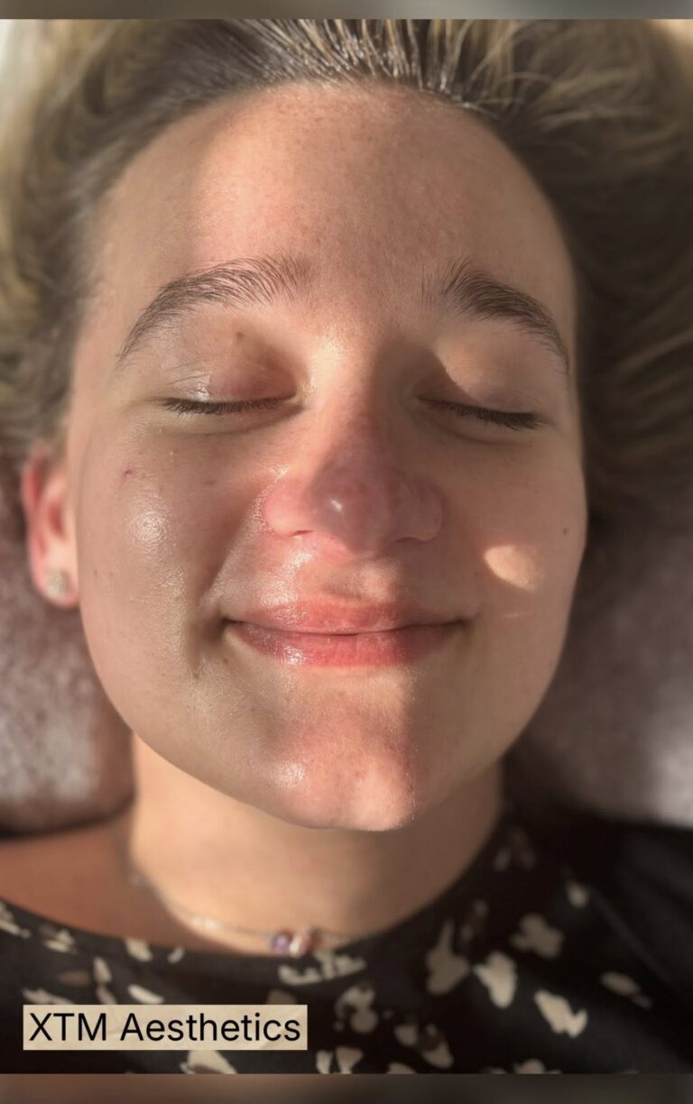 front facial result